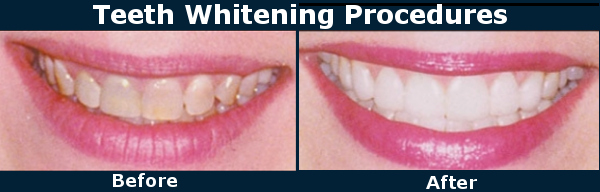 Teeth Whitening Procedures