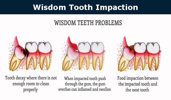 Meaning wisdom teeth Why Do