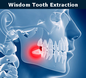 Wisdom Tooth Extraction