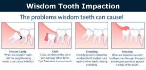 Wisdom Tooth Impaction