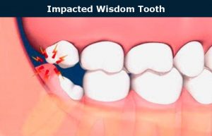 Impacted Tooth Extraction