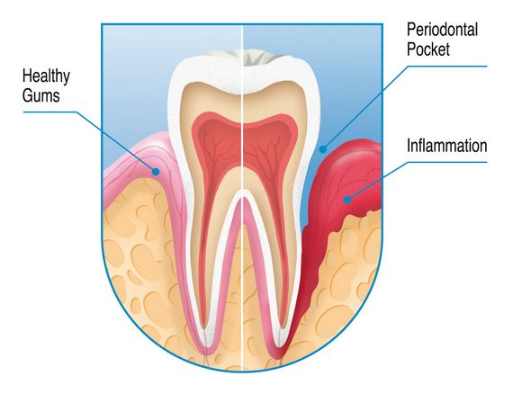 bleeding gums