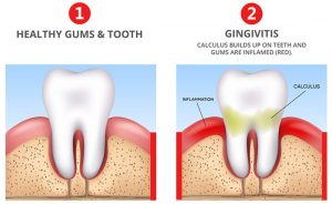 bleeding gums