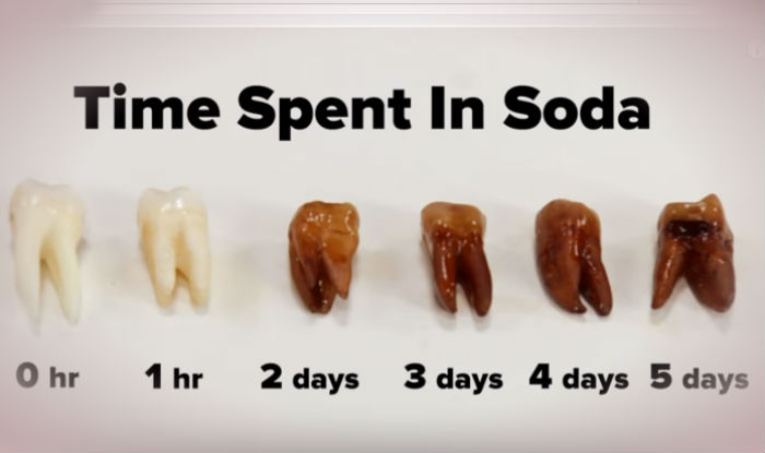 Why Soda Is Terrible for Your Teeth My Dentist Burbank