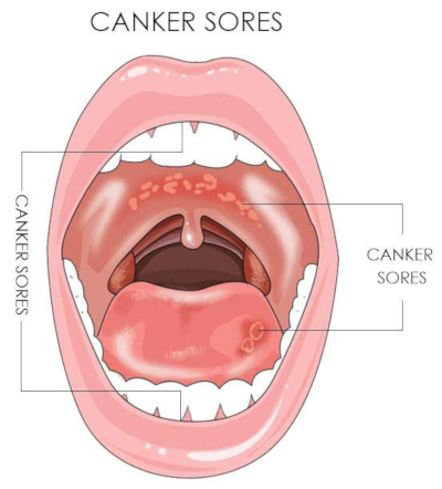 sour spots inside the mouth