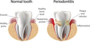 periodontal disease and tooth loss