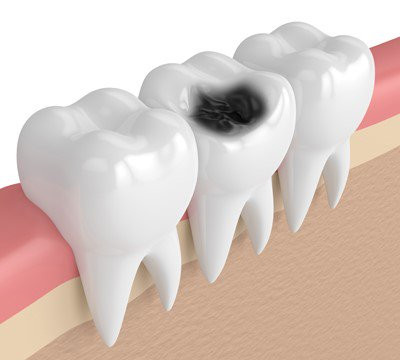 Causes of tooth decay
