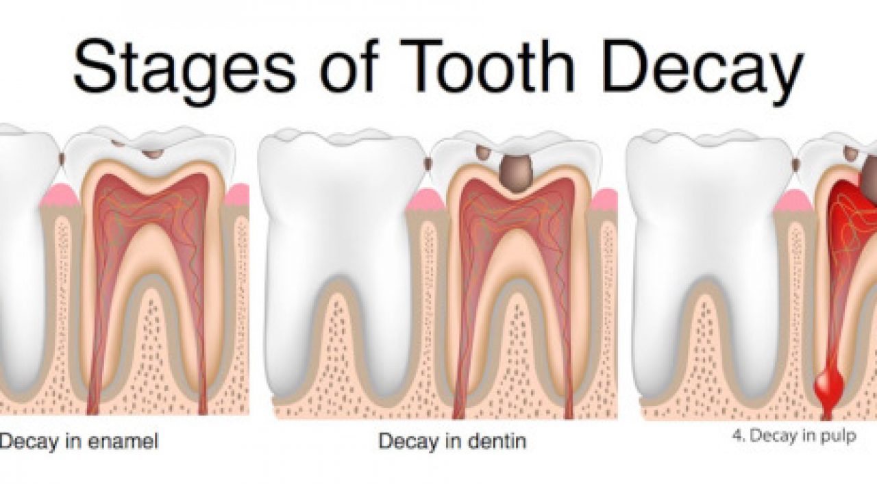 What Does Early Tooth Decay Look Like