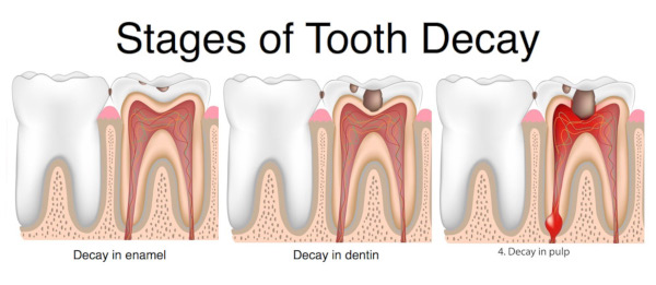 tooth-decay-causes-stages-and-prevention-my-dentist-burbank