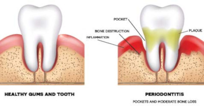 tooth loss