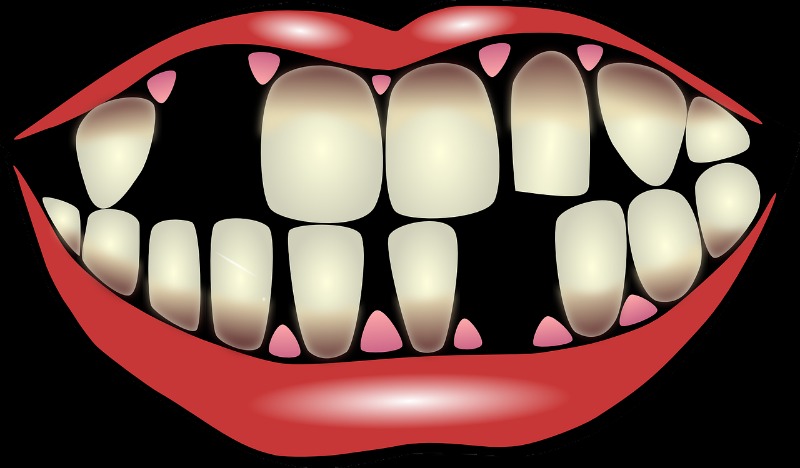 The Dental Problems Caused by a Single Lost Tooth