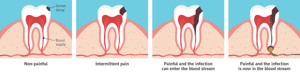 dental caries process