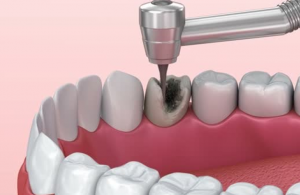 treatment of the cavity