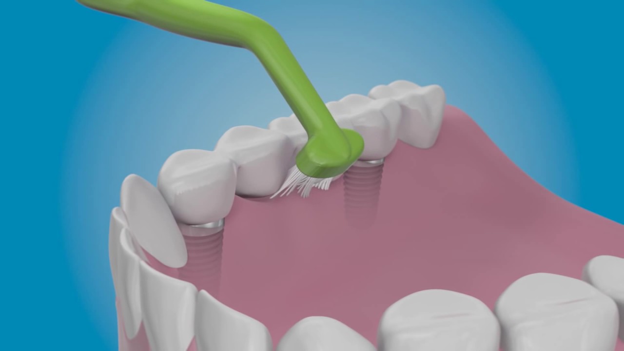 How To Care For Dental Implants My Dentist Burbank