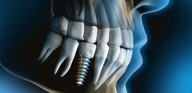 Dental Implant Materials