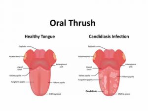 oral trush