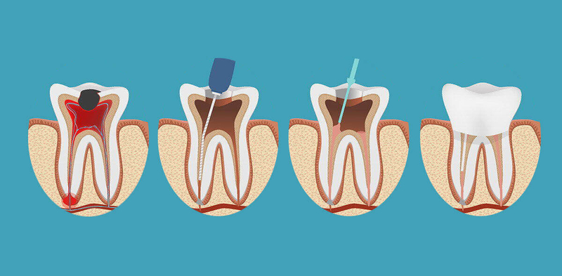 root canal - My Dentist Burbank