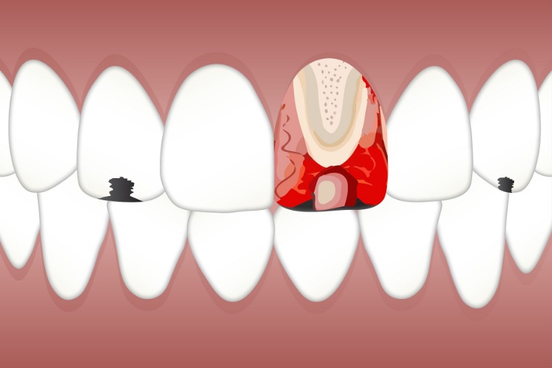 what do cavities look like before the treatment