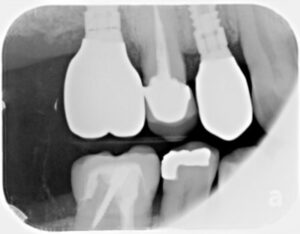 dental implant