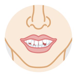 diastema