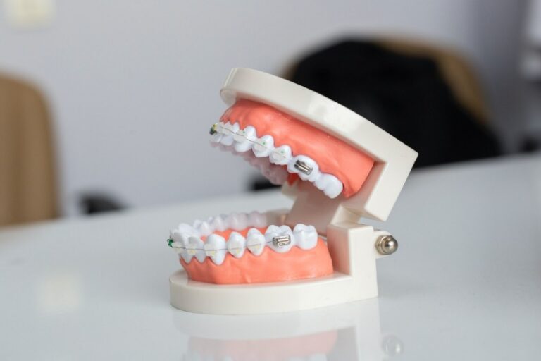 how-to-speed-up-your-braces-process-my-dentist-burbank