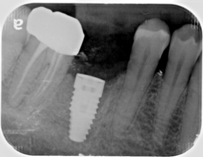 dental implant