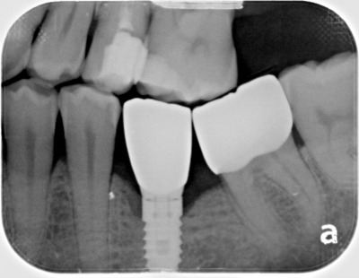 dental implant