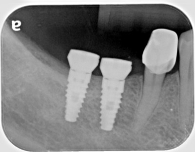 dental implant