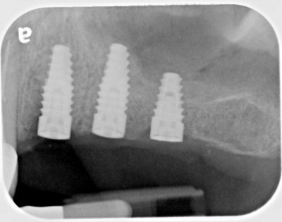 dental implant