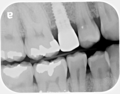 dental implant