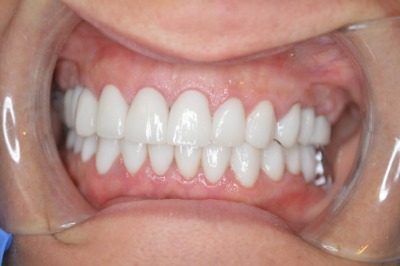 What Are Those Craze-y Lines in My Teeth?