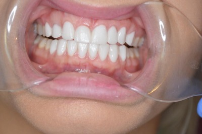 What Are the Different Types of Braces, and Which Is Right for Me? - My  Dentist Burbank