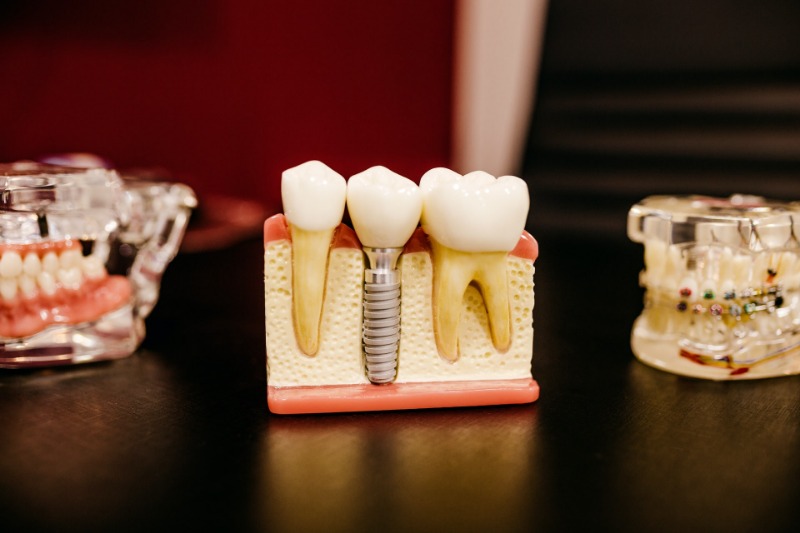 Dental Implant Care: 7 Tips for Looking After Your Implants - My Dentist  Burbank