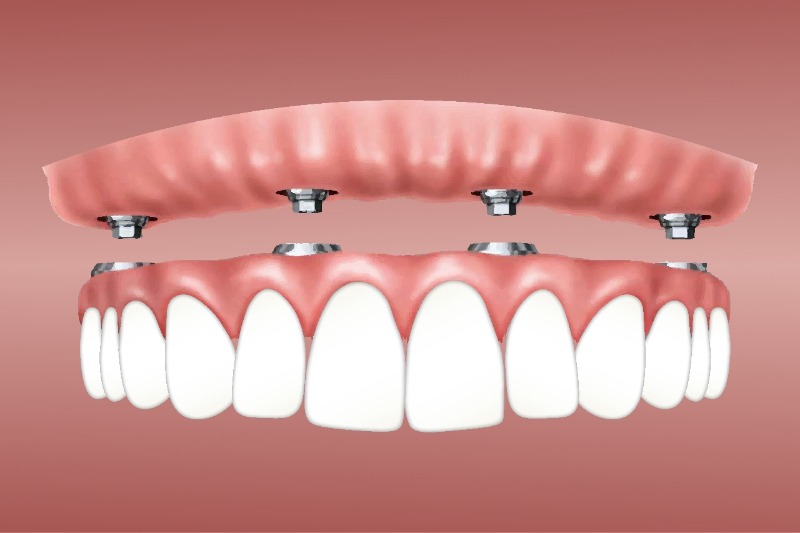 Missing Teeth? The Successful Tooth Replacement Options