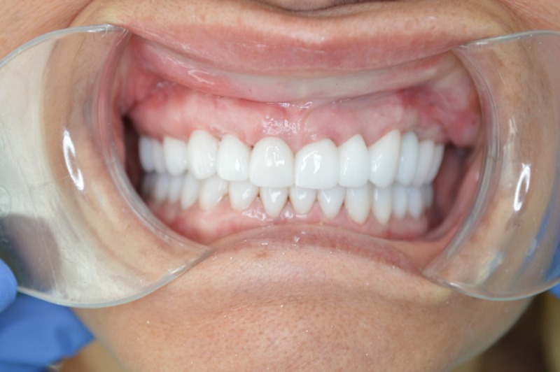 What Are The Steps of a Full Mouth Reconstruction? - My Dentist