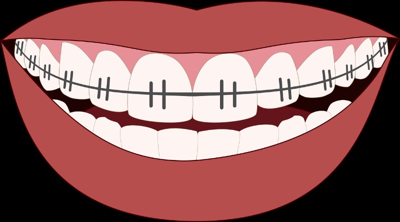 braces