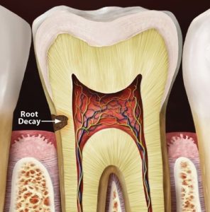 root decay