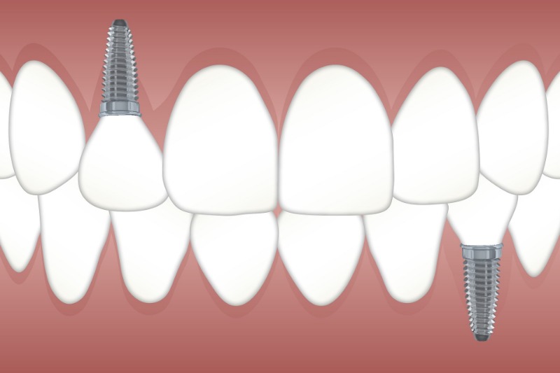 Dental implants fail at a rate 10 times that of natural teeth in patients  with treated chronic periodontitis: New study