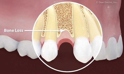 missing tooth