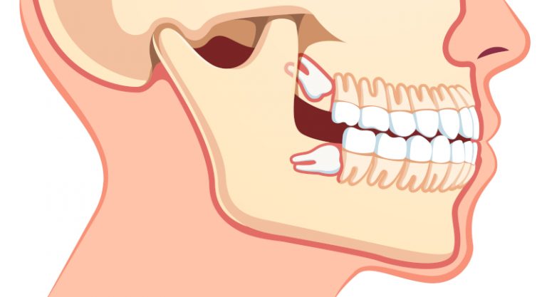 what causes perfect teeth to shift in adults