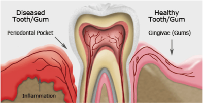 gum disease