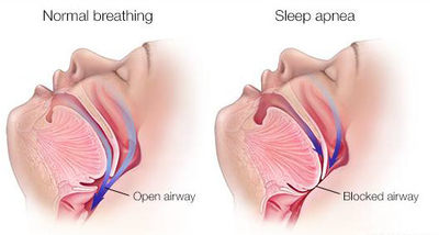 sleep apnea