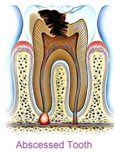 abcessed tooth