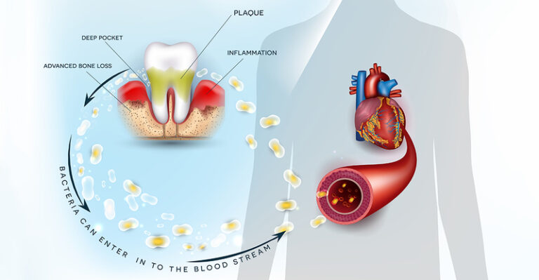 the-effects-of-a-tooth-infection-on-your-overall-health-my-dentist