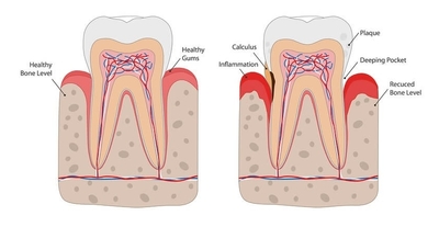 Tooth Infection Skeleton tooth infection - My Dentist Burbank