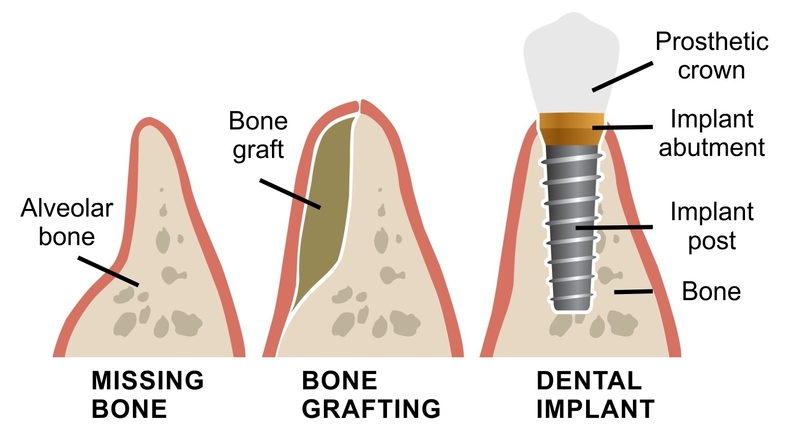 bone grafting