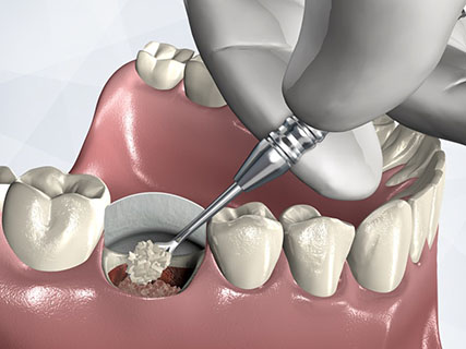 dental extraction and socket preservation