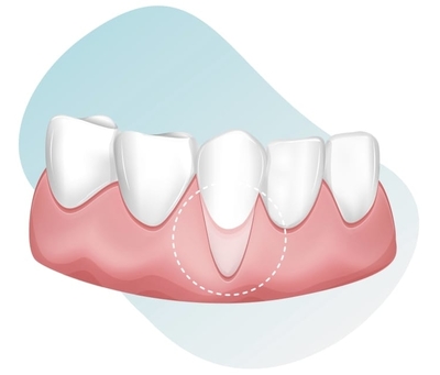 receding gums