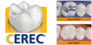 cerec crown