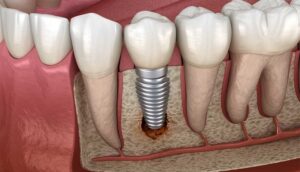 dental implant failure